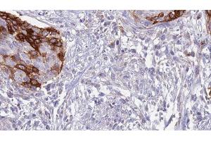 ABIN6273638 at 1/100 staining Human urothelial cancer tissue by IHC-P. (IL12RB1 antibody  (Internal Region))