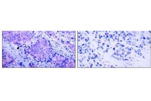 Immunohistochemical analysis of paraffin- embedded human breast carcinoma tissue using PDK1 (phospho-Ser241) antibody (E011005). (PDPK1 antibody  (pSer241))