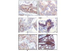 Immunohistochemical analysis of paraffin-embedded human gastric adenocarcinoma(A), golon adenocarcinoma (B), endometrial carcinoma (uterus) (C), ovary adenocarcinoma (D), lung squamous cell carcinoma (E), stomach epithelium mucosae (F), showing membrane localization using IGF1R mouse mAb with DAB staining. (IGF1R antibody)