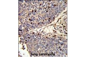 Formalin-fixed and paraffin-embedded human lung carcinoma reacted with CFL1 Antibody (N-term), which was peroxidase-conjugated to the secondary antibody, followed by DAB staining.