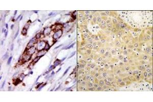 (LEFT)Formalin-fixed and paraffin-embedded human cancer tissue reacted with the primary antibody, which was peroxidase-conjugated to the secondary antibody, followed by DAB staining. (GRK5 antibody  (C-Term))