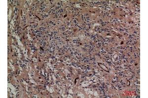 Immunohistochemistry (IHC) analysis of paraffin-embedded Human Ovary Cancer, antibody was diluted at 1:100. (SNAP23 antibody  (C-Term))