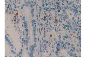IHC-P analysis of Human Stomach cancer Tissue, with DAB staining. (LAMC2 antibody  (AA 416-602))