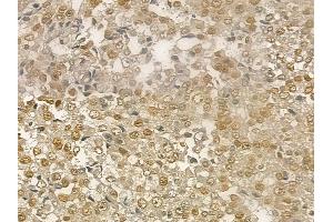 ABIN6256102 and ABIN6267201 at 1/100 staining human prostate carcinoma by IHC-P.