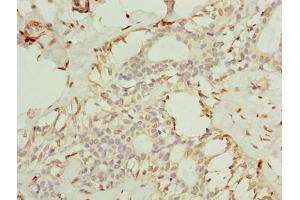 Immunohistochemistry of paraffin-embedded human breast cancer using ABIN7173079 at dilution of 1:100 (TMEM154 antibody  (AA 97-183))
