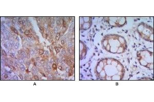 Immunohistochemical analysis of paraffin-embedded human lung cancer (A), colon cancer (B) using ST13 mouse mAb with DAB staining. (HSC70 Interacting Protein HIP antibody)