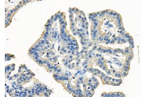 ABIN6260625 and ABIN6278437 at 1/100 staining Human lung cancer by IHC-P.
