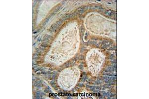 INSIG1 Antibody immunohistochemistry analysis in formalin fixed and paraffin embedded human prostate carcinoma followed by peroxidase conjugation of the secondary antibody and DAB staining. (INSIG1 antibody  (N-Term))