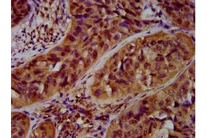 IHC image of ABIN7167931 diluted at 1:600 and staining in paraffin-embedded human cervical cancer performed on a Leica BondTM system. (ARHGAP15 antibody  (AA 1-154))