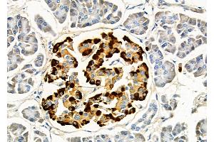 ABIN6257133 and ABIN6275805 at 1/100 staining Human pancreatic cancer and adjacent nomal tissues by IHC-P.