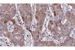 ABIN6276659 at 1/100 staining Human liver cancer tissue by IHC-P. (CD44 antibody  (Internal Region))