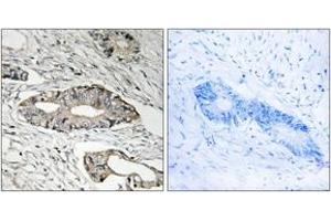 Immunohistochemistry analysis of paraffin-embedded human colon carcinoma tissue, using EPN3 Antibody. (EPN3 antibody  (AA 401-450))