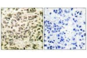 Immunohistochemical analysis of paraffin-embedded human breast carcinoma tissue using HDAC3 antibody. (HDAC3 antibody  (C-Term))