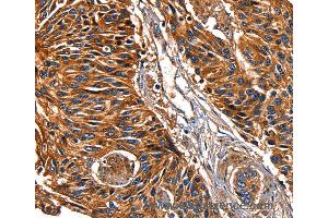 Immunohistochemistry of Human lung cancer using LGALS8 Polyclonal Antibody at dilution of 1:50 (LGALS8 antibody)