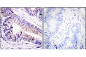 Immunohistochemistry analysis of paraffin-embedded human colon carcinoma tissue, using 14-3-3 zeta/delta (Ab-232) Antibody. (14-3-3 zeta antibody  (AA 196-245))