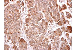 IHC-P Image TMEM59 antibody detects TMEM59 protein at cytosol on human ovarian carcinoma by immunohistochemical analysis. (TMEM59 antibody)