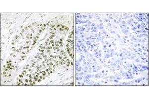 Immunohistochemistry analysis of paraffin-embedded human lung carcinoma, using ATF2 (Phospho-Ser480) Antibody. (ATF2 antibody  (pSer480))