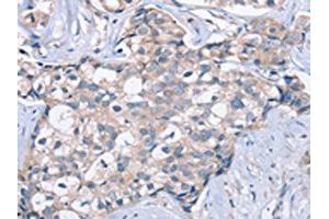 The image on the left is immunohistochemistry of paraffin-embedded Human breast cancer tissue using ABIN7129969(KCNQ5 Antibody) at dilution 1/60, on the right is treated with fusion protein. (KCNQ5 antibody)