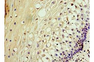 Immunohistochemistry of paraffin-embedded human cervical cancer using ABIN7142902 at dilution of 1:100 (AKAP1 antibody  (AA 413-662))