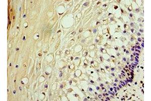 Immunohistochemistry of paraffin-embedded human cervical cancer using ABIN7142902 at dilution of 1:100