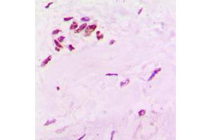 Immunohistochemical analysis of SOX6 staining in human lung cancer formalin fixed paraffin embedded tissue section. (SOX6 antibody  (N-Term))