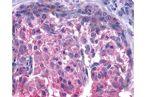 Anti-BOB / GPR15 antibody IHC of human Skin, Melanoma. (GPR15 antibody  (C-Term))