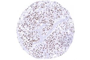Urinary bladder Muscle invasive urothelial carcinoma with moderate to strong GATA3 immunostaining of tumor cells (GATA3 antibody)