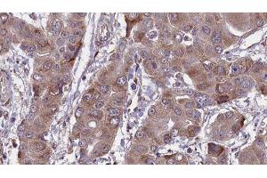 ABIN6276678 at 1/100 staining Human liver cancer tissue by IHC-P. (CA2 antibody  (C-Term))