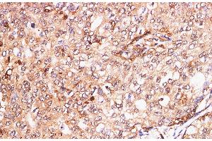 Immunohistochemistry of paraffin-embedded Human breast cancer using S100A11 Polyclonal Antibody at dilution of 1:200 (S100A11 antibody)