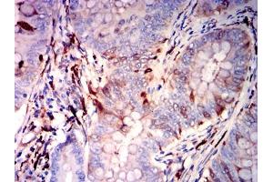 Immunohistochemical analysis of paraffin-embedded rectal cancer tissues using GSN mouse mAb with DAB staining. (Gelsolin antibody)