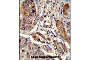 Formalin-fixed and paraffin-embedded human hepatocarcinoma reacted with EBP Antibody (N-term), which was peroxidase-conjugated to the secondary antibody, followed by DAB staining. (EBP antibody  (N-Term))