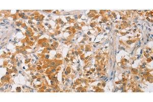 Immunohistochemistry of paraffin-embedded Human thyroid cancer using ARMCX3 Polyclonal Antibody at dilution of 1:40 (ARMCX3 antibody)