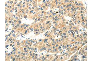 The image on the left is immunohistochemistry of paraffin-embedded Human liver cancer tissue using ABIN7193040(WDR36 Antibody) at dilution 1/35, on the right is treated with synthetic peptide. (WDR36 antibody)