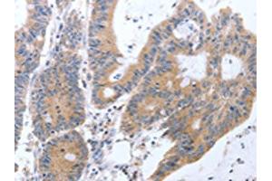The image on the left is immunohistochemistry of paraffin-embedded Human colon cancer tissue using ABIN7131299(TAT Antibody) at dilution 1/35, on the right is treated with fusion protein. (Tat antibody)