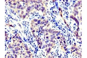 IHC image of ABIN7158430 diluted at 1:300 and staining in paraffin-embedded human pancreatic cancer performed on a Leica BondTM system. (LPP antibody  (AA 227-391))