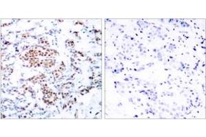 Immunohistochemistry analysis of paraffin-embedded human breast carcinoma tissue, using STAT5A (Ab-694) Antibody. (STAT5A antibody  (AA 666-715))