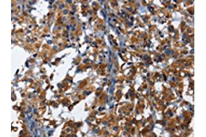The image on the left is immunohistochemistry of paraffin-embedded Human thyroid cancer tissue using ABIN7130029(KLRB1 Antibody) at dilution 1/40, on the right is treated with fusion protein. (CD161 antibody)