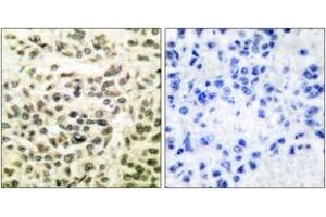 Immunohistochemistry analysis of paraffin-embedded human breast carcinoma tissue, using GSK3 alpha/beta (Ab-279/216) Antibody. (GSK3 alpha/beta antibody  (AA 246-295))