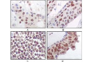 Immunohistochemical analysis of paraffin-embedded human liver carcinoma (A), esophagus carcinoma (B), normal spleen tissue(C), breast carcinoma (D), showing nuclear and cytoplasmic localization using PRAK mouse mAb with DAB staining. (MAPKAP Kinase 5 antibody)