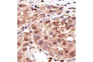 Formalin-fixed and paraffin-embedded human cancer tissue reacted with the primary antibody, which was peroxidase-conjugated to the secondary antibody, followed by AEC staining. (MTM1 antibody  (N-Term))