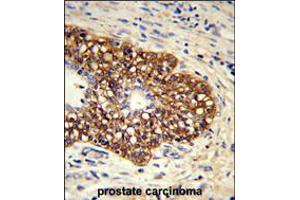 Formalin-fixed and paraffin-embedded human prostate carcinoma reacted with CYP8A1 Antibody , which was peroxidase-conjugated to the secondary antibody, followed by DAB staining.