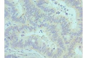 Immunohistochemistry of paraffin-embedded human colon cancer using ABIN7147246 at dilution of 1:100 (CADM1 antibody  (AA 45-344))