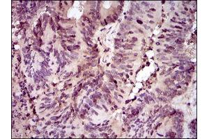 Immunohistochemical analysis of paraffin-embedded colon cancer tissues using PCNA mouse mAb with DAB staining. (PCNA antibody  (AA 53-196))
