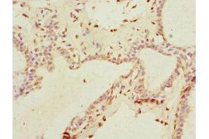 Immunohistochemistry of paraffin-embedded human breast cancer using ABIN7172156 at dilution of 1:100 (THRSP antibody  (AA 1-146))