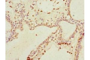 Immunohistochemistry of paraffin-embedded human breast cancer using ABIN7172156 at dilution of 1:100