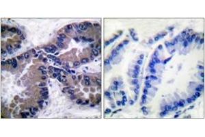 Immunohistochemistry analysis of paraffin-embedded human lung carcinoma tissue, using Nrf2 Antibody.