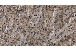 Immunohistochemistry of paraffin-embedded Human liver cancer using HIST1H2AH Polyclonal Antibody at dilution of 1:40 (HIST1H2AH antibody)