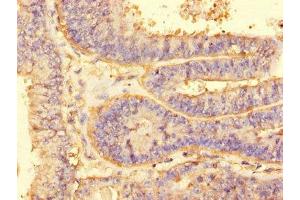 Immunohistochemistry of paraffin-embedded human endometrial cancer using ABIN7143770 at dilution of 1:100 (ALG2 antibody  (AA 303-405))