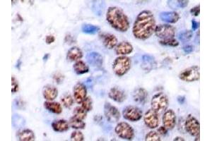 Immunohistochemistry Analysis: AP20196PU-N NFκB-p65 antibody staining of Paraffin-Embedded Human breast carcinoma tissue. (NF-kB p65 antibody)