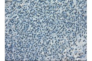 Immunohistochemical staining of paraffin-embedded lymphoma tissue using anti-PORmouse monoclonal antibody. (POR antibody)